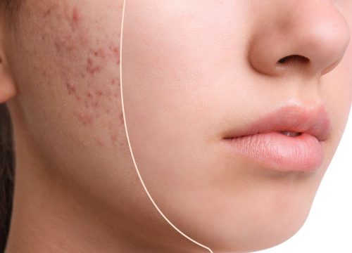 Woman with acne and acne scarring on her face