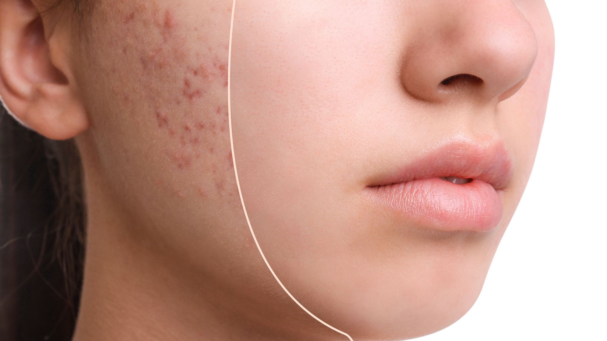 Acne and Acne Scarring