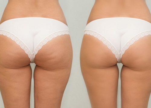 Women's buttocks