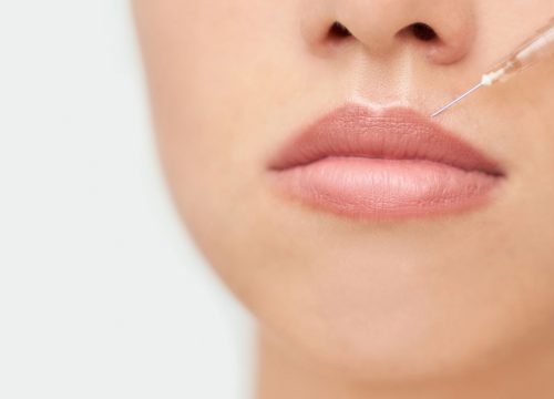 Woman receiving dermal fillers in her lips