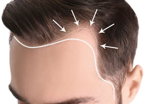 Hair loss along a man's hairline