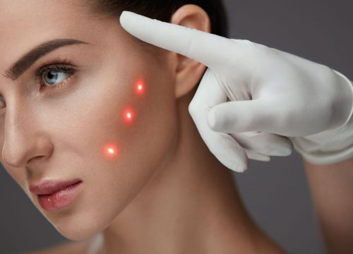 Woman receiving MicroLaser Peels treatment