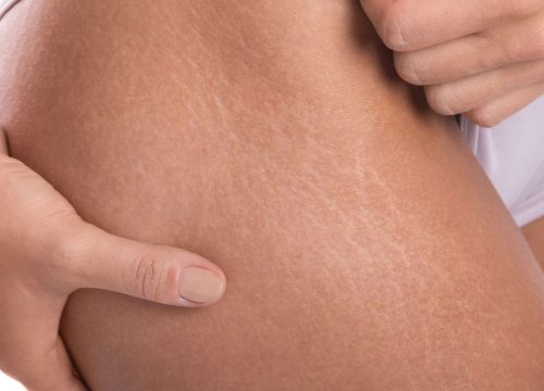 Stretch marks on a woman's leg