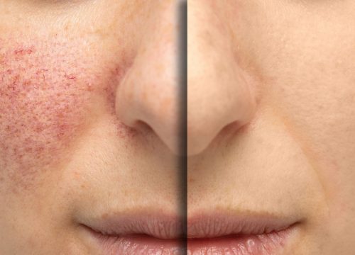 Vascular lesions on a woman's face