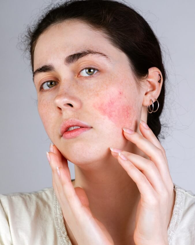 Woman Suffering From Rosacea