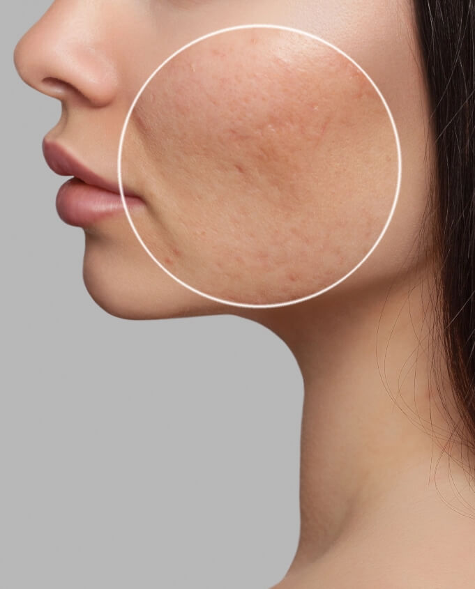 Acne and Acne Scar Occur