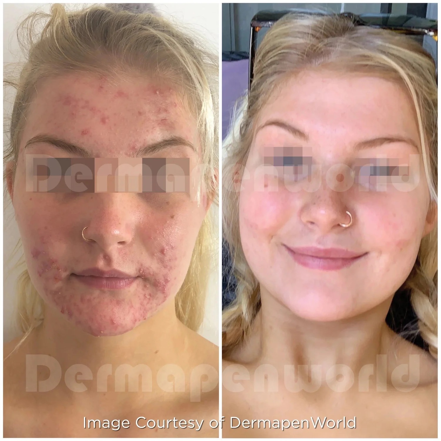 Dermapenmicroneedlingdp4treatmentbeforeafter acne 1