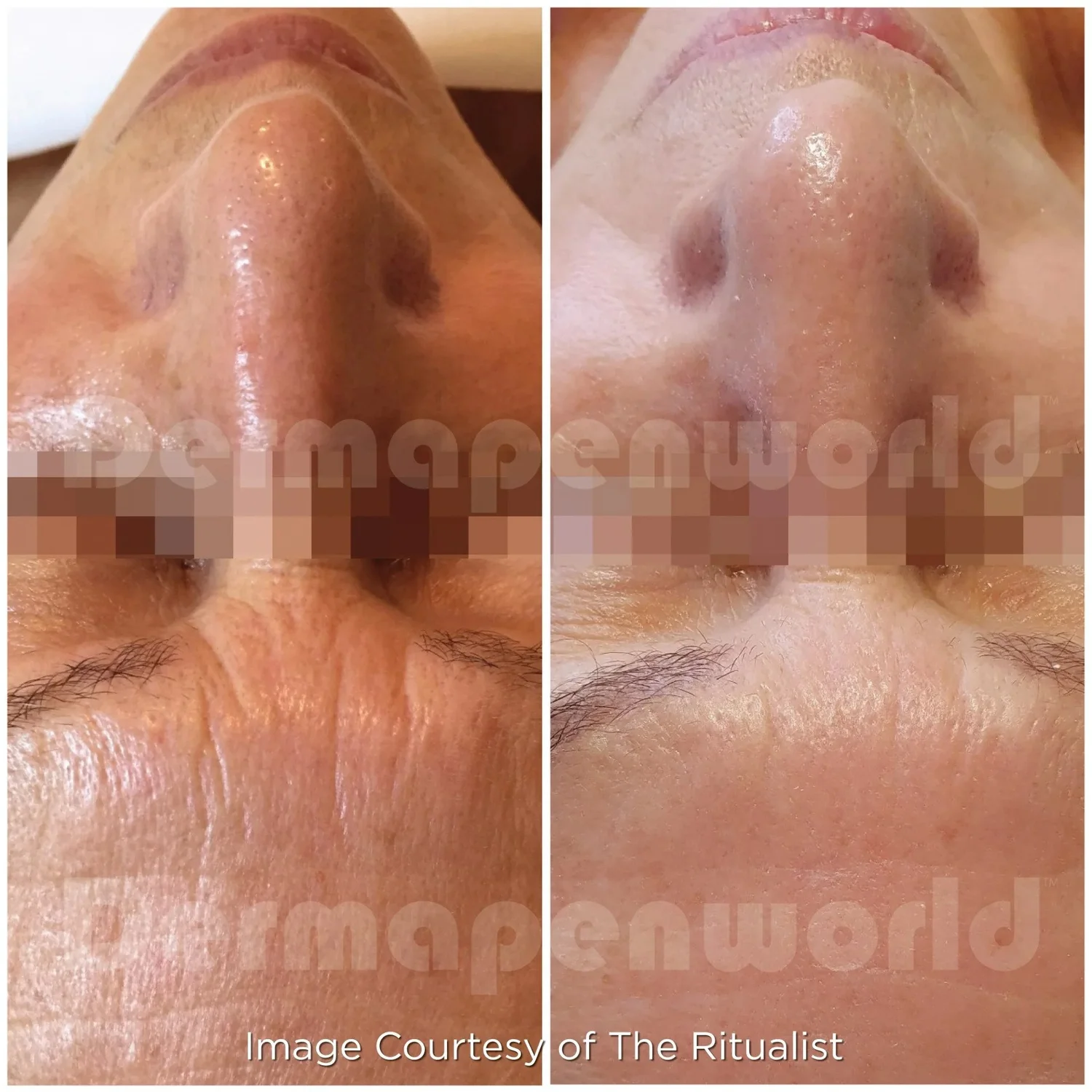 Dermapenmicroneedlingdp4treatmentbeforeafter wrinkles