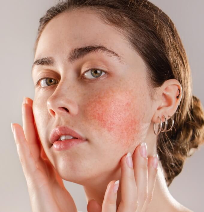 Rosacea On Skin