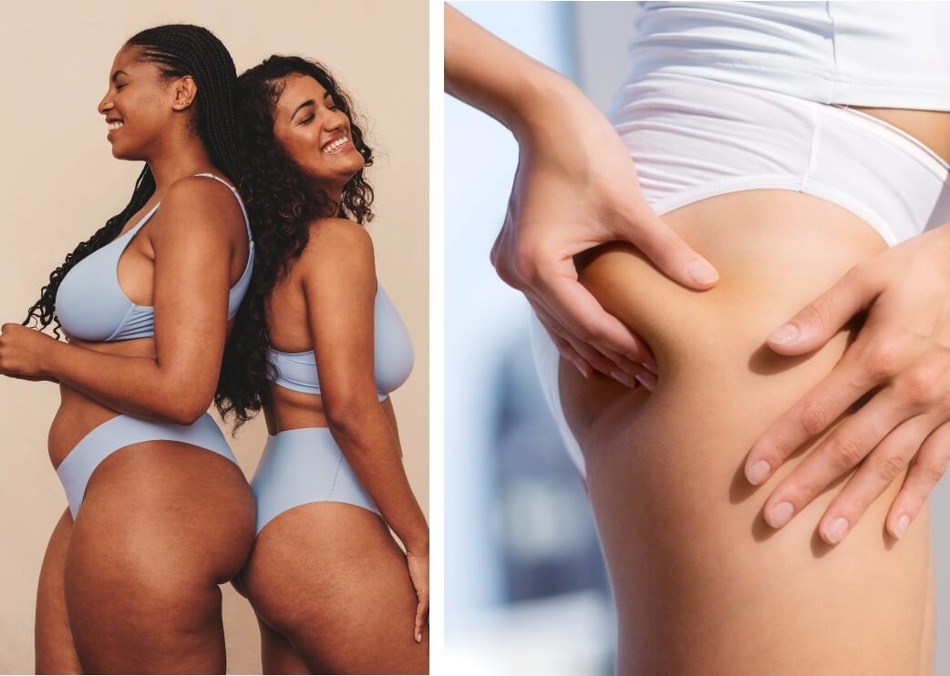 Sign Of Cellulite