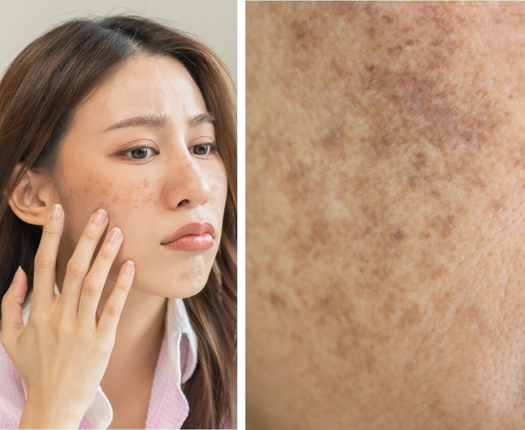 Signs Of Melasma