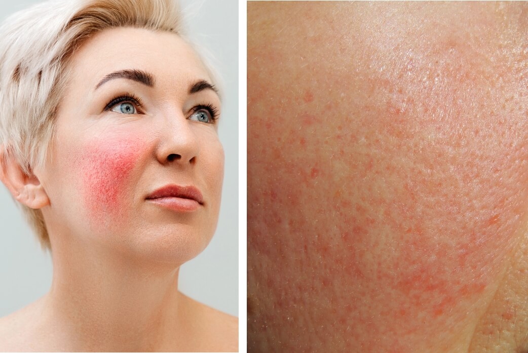 Signs Of Rosacea