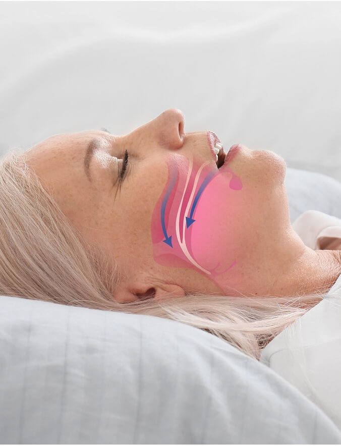 Snoring Treatment