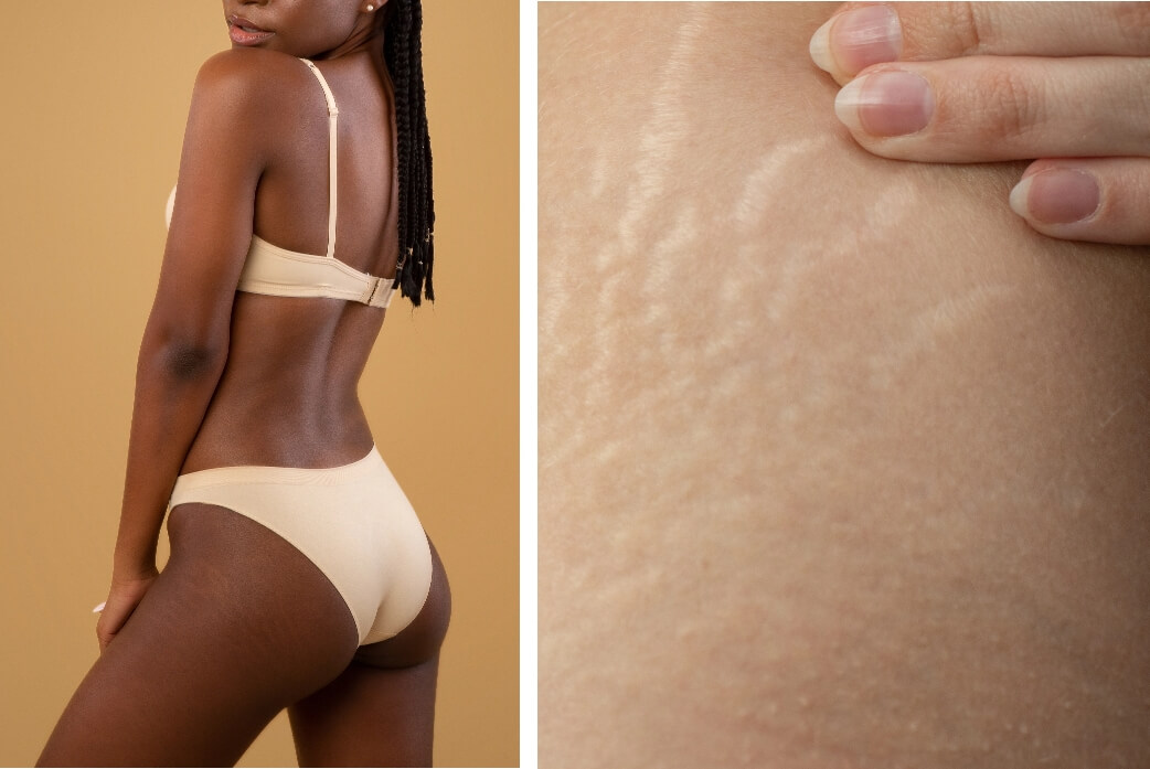 Stretch Marks Sign