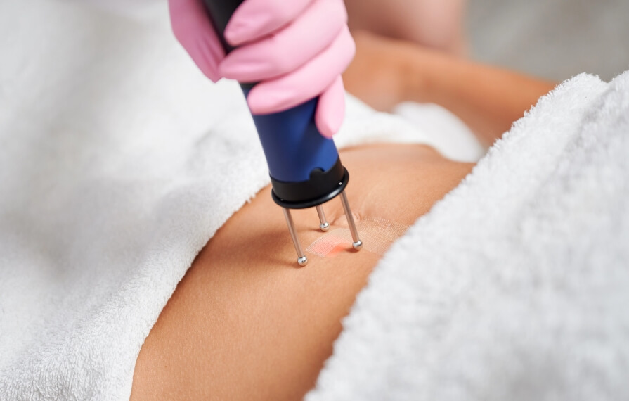 TightSculpting Laser