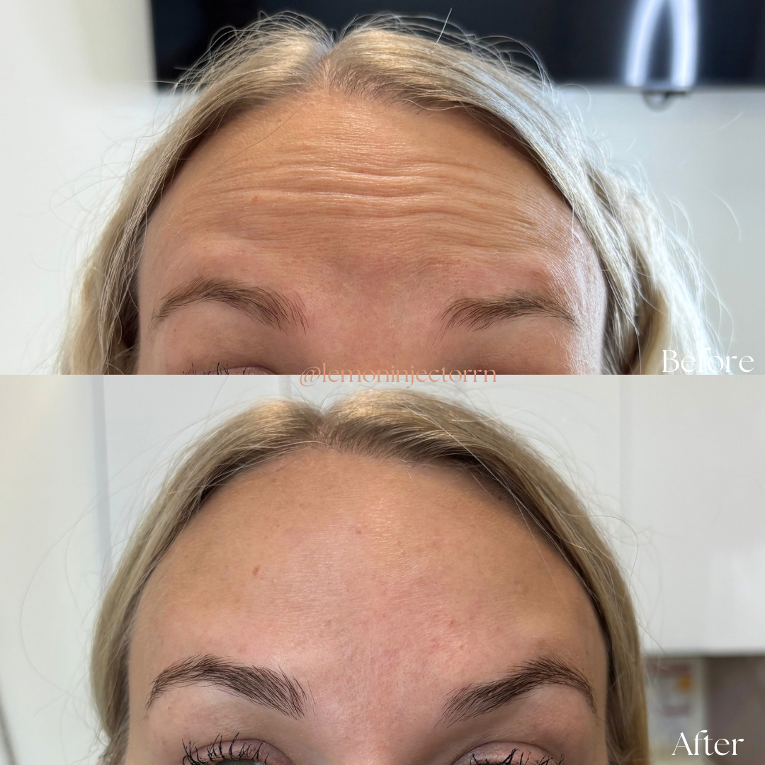 Botox