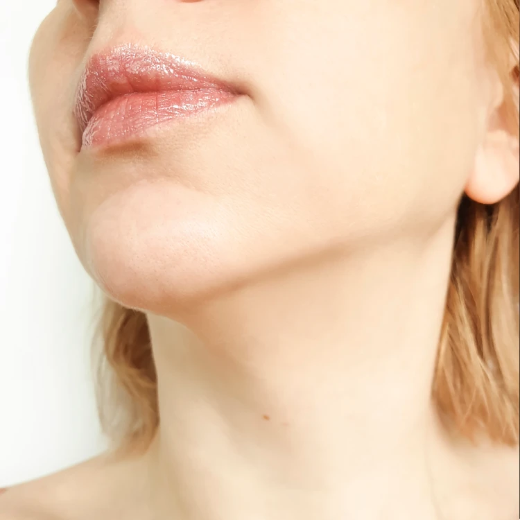 Skin tightening after 1