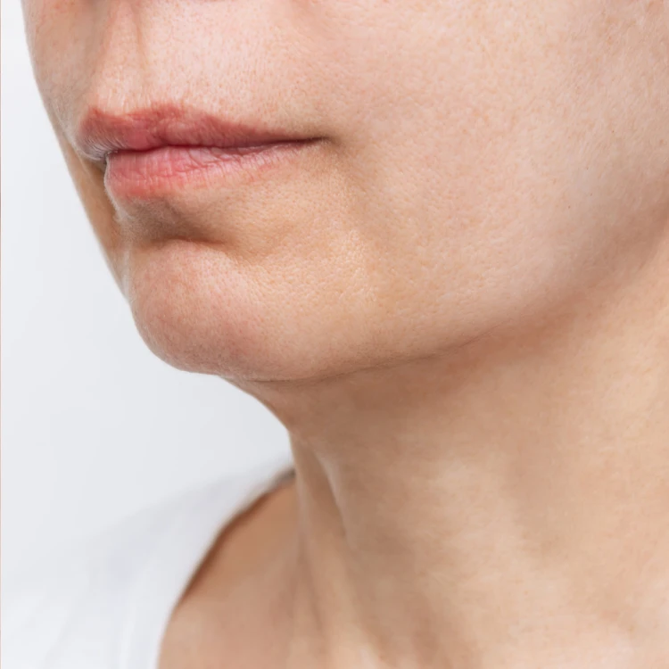 Skin tightening after 3