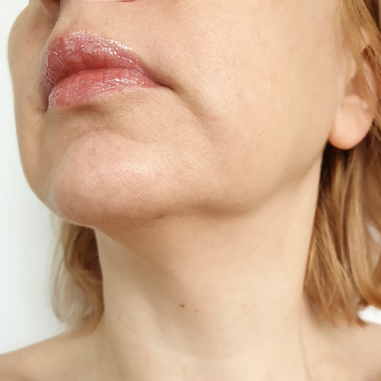 Skin tightening before 1