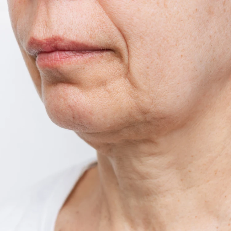 Skin tightening before 3