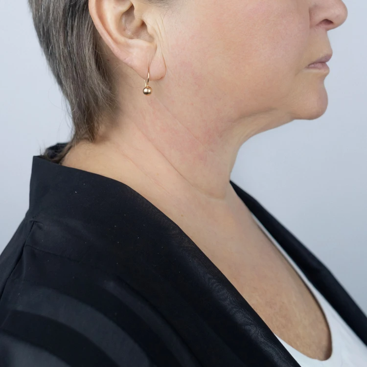 Skin tightening after 2