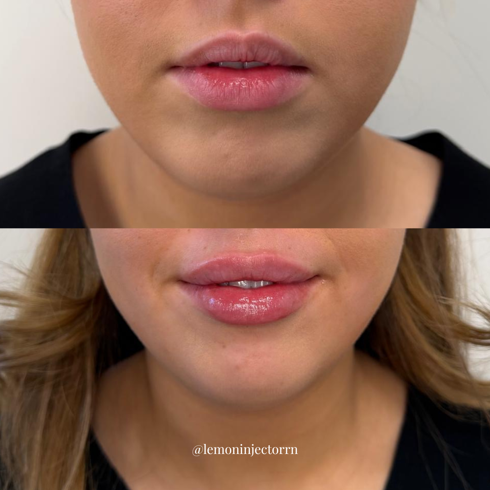 Lips 1 3
